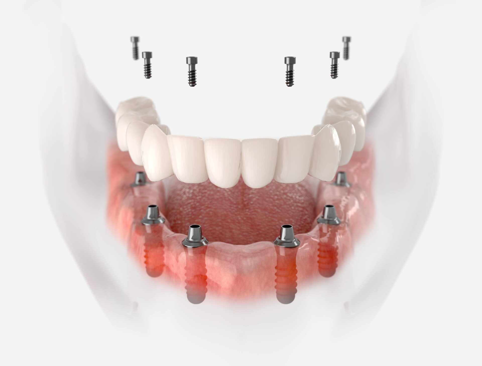 Full Arch Dental Implants. Full Arch Dental Reconstruction